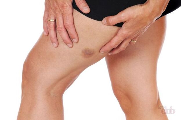 όταν σκάει μια φλέβα