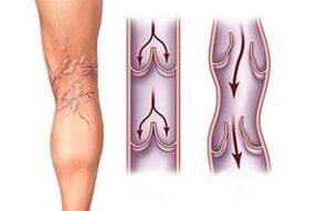 Εκκένωση αίματος σε κιρσούς σε διάφορα στάδια ανάπτυξης της νόσου